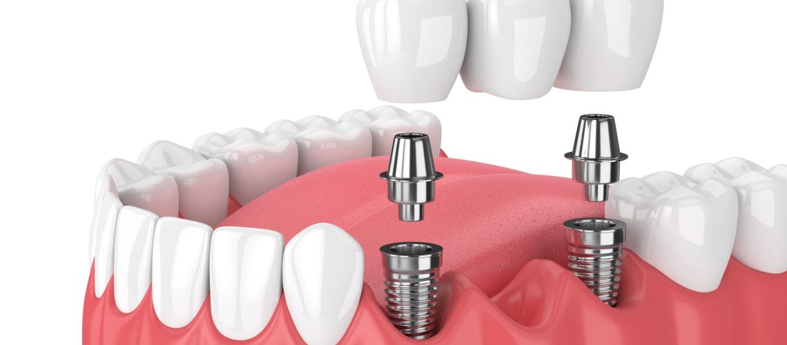 What are the Benefits of Mini Dental Implants?