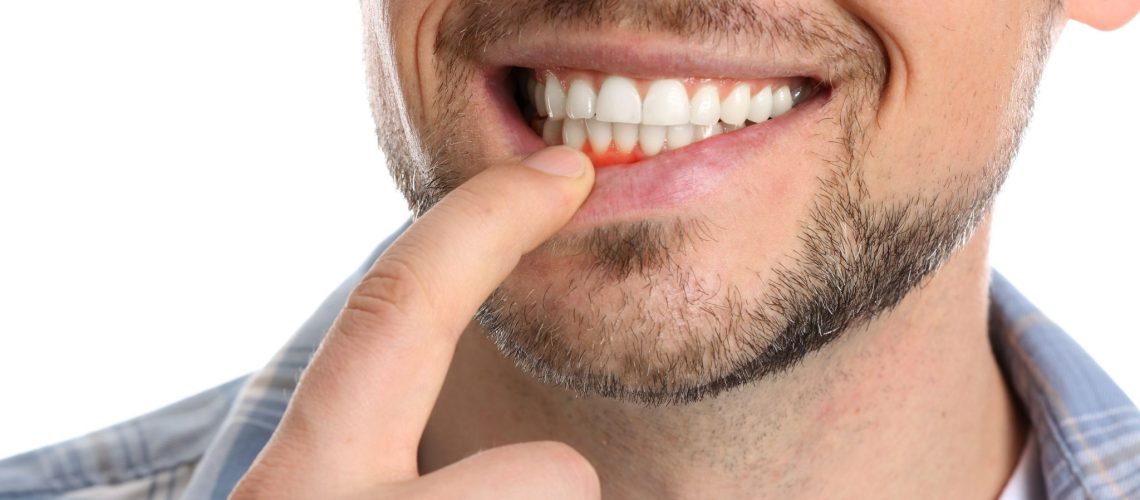 What Can I Do About Receding Gums?