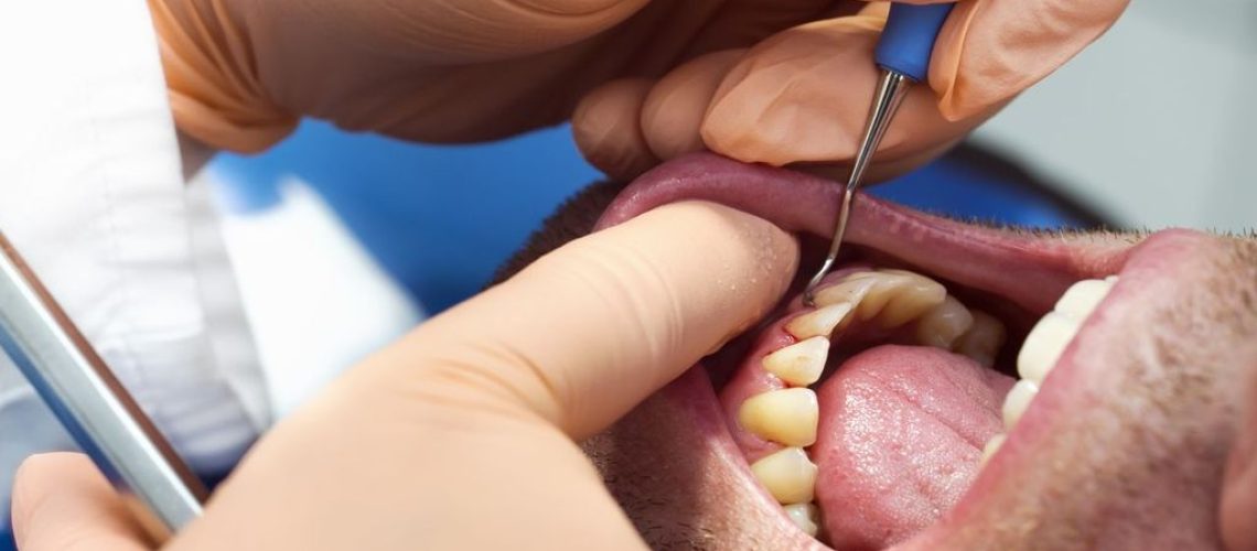 What Causes Red Gums to Appear Around One Tooth?