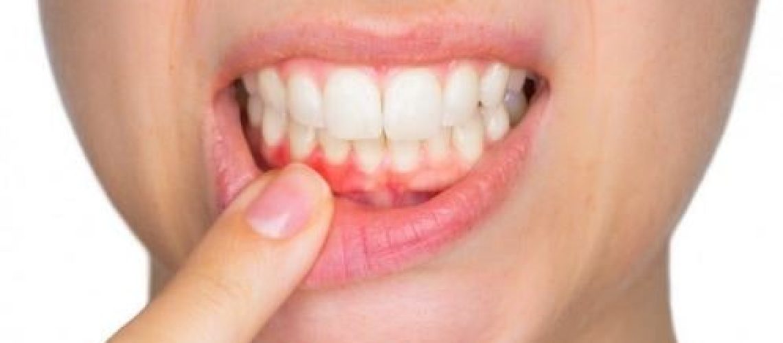 How Do You Treat Bleeding Gums?