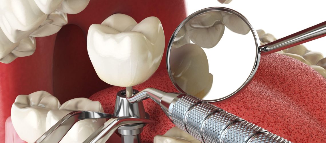 The 6 Steps of Dental Implant Placement
