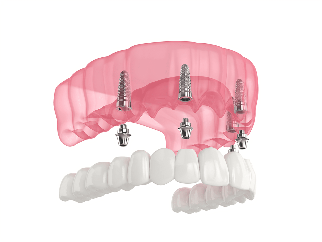 What are All-On-4s Dental Implants?