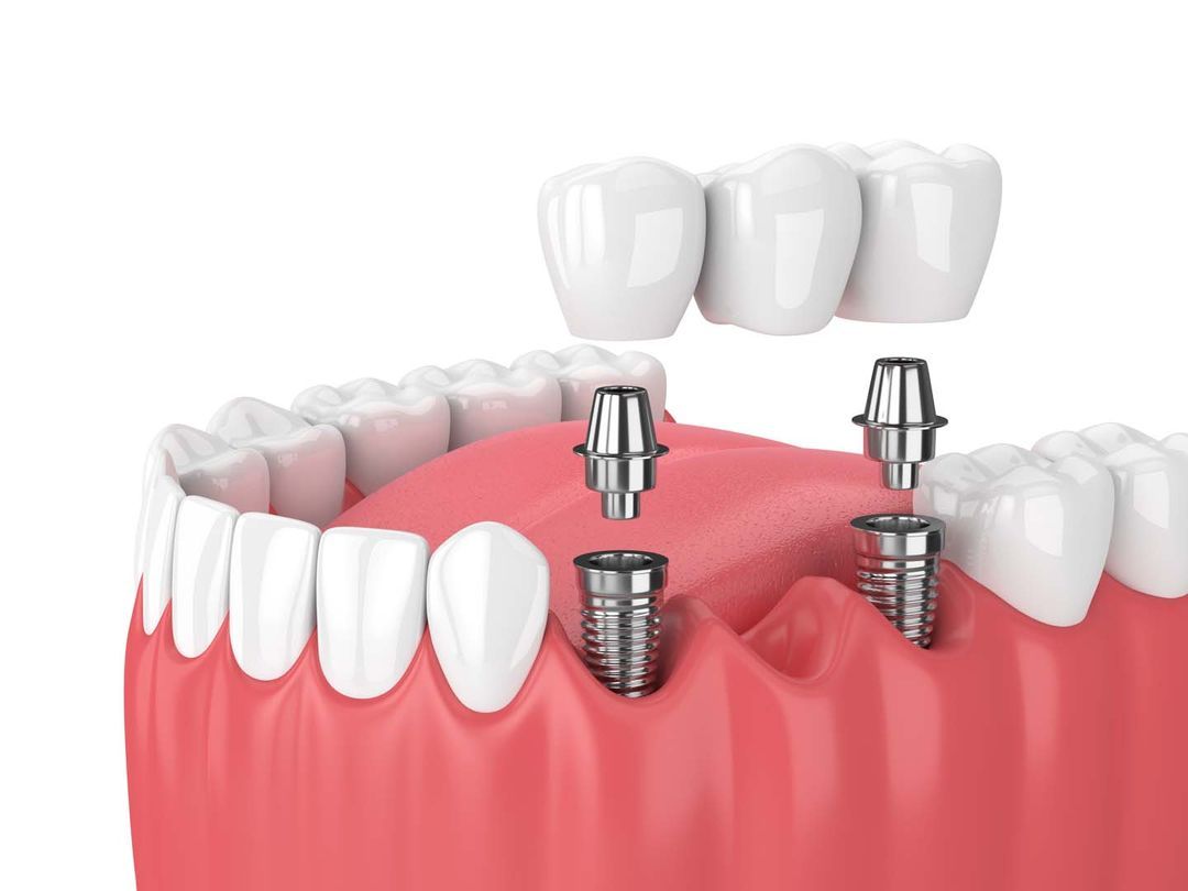 What Should You Not Eat After Getting Dental Implants?