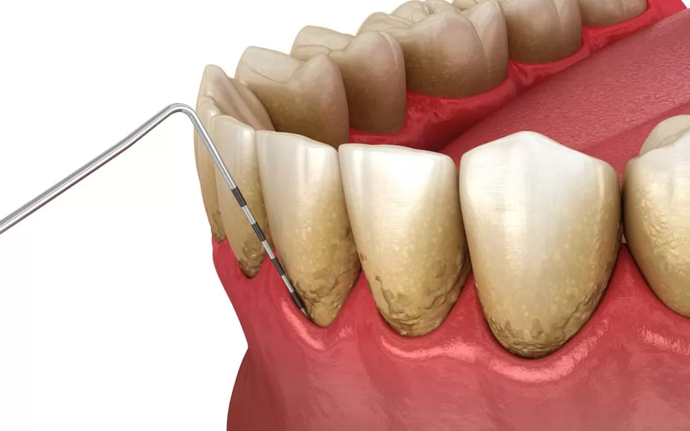 The Connection Between Gum Disease and COPD: What Denver Residents Need to Know